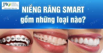 Niềng răng SMART bao gồm những loại nào? Loại nào tốt nhất