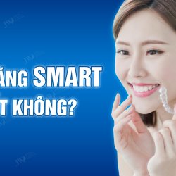 Niềng răng SMART là gì, có tốt không?