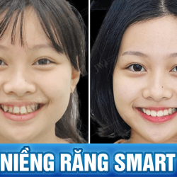 Niềng răng SMART có mắc không?