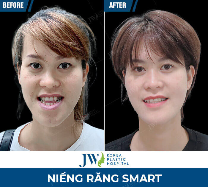 nieng-rang-smart-jw1
