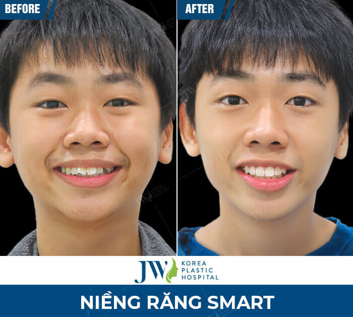 nieng-rang-smart-jw-2