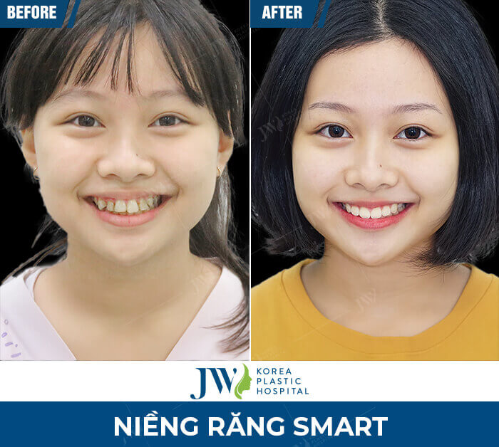 nieng-rang-smart-jw-3