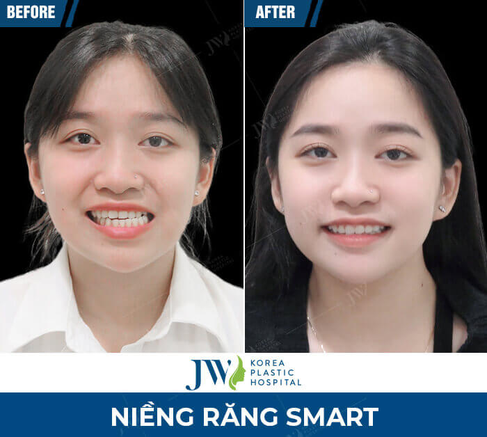 nieng-rang-smart-jw-4