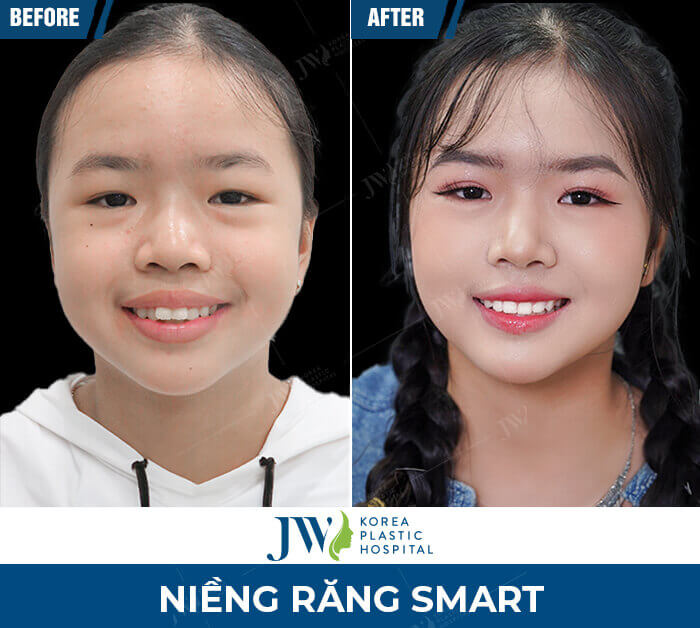 nieng-rang-smart-jw5