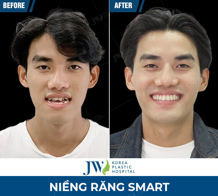 nieng-rang-smart-jw-6