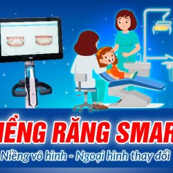 Niềng răng SMART là gì ? Giải mã cơn sốt niềng vô hình thay đổi ngoại hình