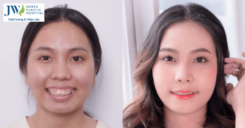 Phẫu thuật hàm hô – Giải pháp thần kỳ giúp bạn thay đổi diện mạo