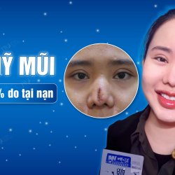 Bác sĩ Tú Dung giải cứu thành công cô gái xém mất mũi vì tai nạn 