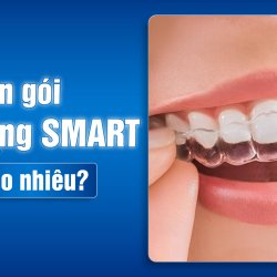 Trọn gói Niềng răng SMART giá bao nhiêu?