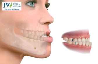 Bị móm có bọc răng sứ được không – Nha khoa Bệnh viện JW