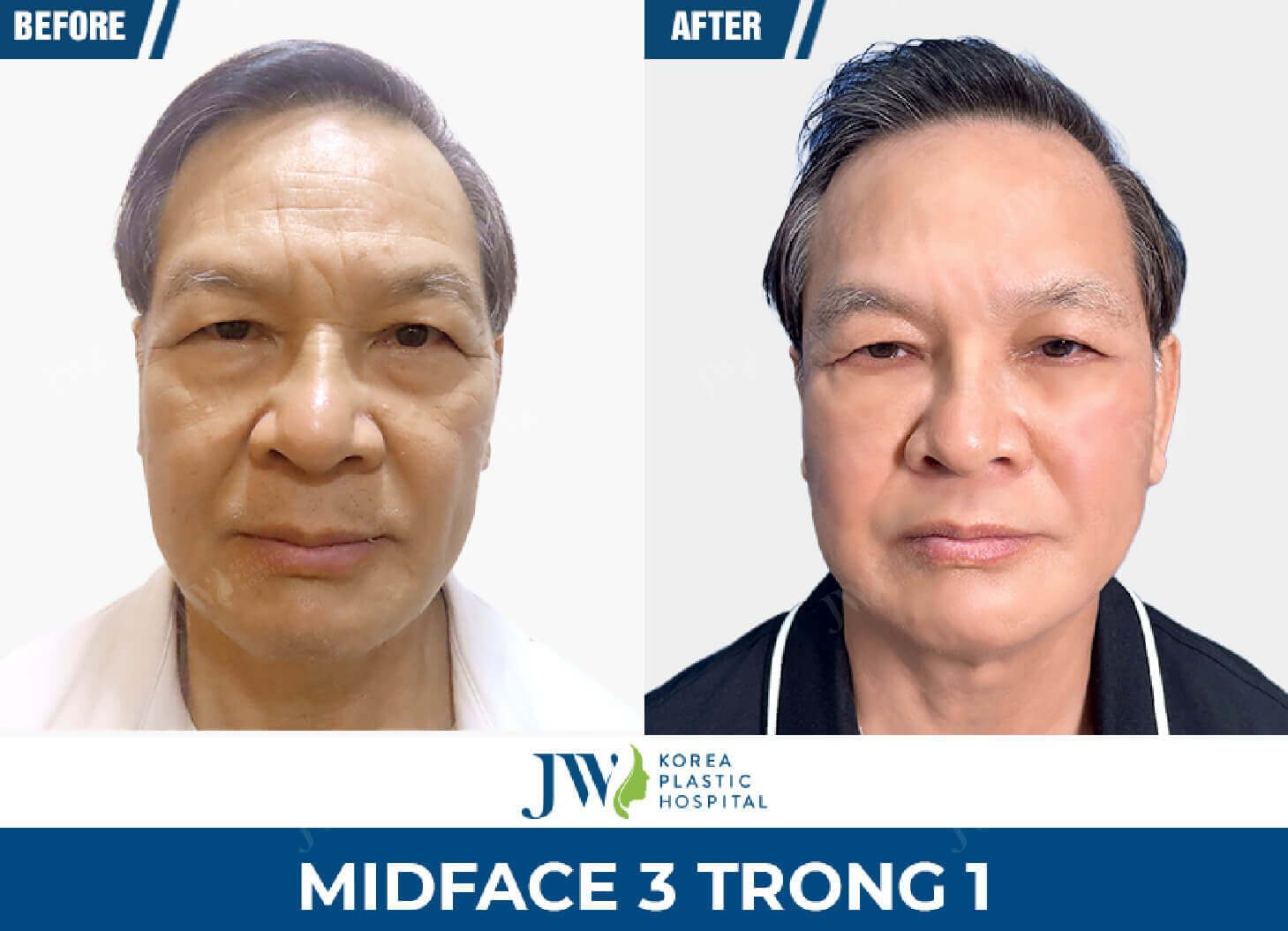 midface 3in1 