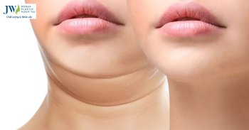 tướng số người 2 cằm