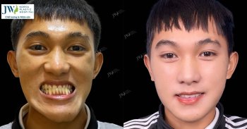 Nhan sắc thăng hạng của hotboy Tây Ninh sau phẫu thuật hàm