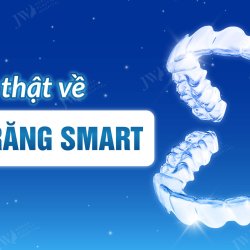 Sự thật về niềng răng SMART mà bạn nên biết 