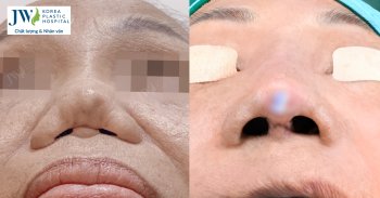 Người phụ nữ miền Tây sửa mũi 7 lần suýt tắt thở
