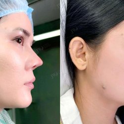 “Hô biến” mũi cao Tây hỏng thành mũi S Line cho cô gái miền Tây