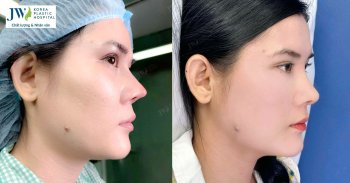 “Hô biến” mũi cao Tây hỏng thành mũi S Line cho cô gái miền Tây
