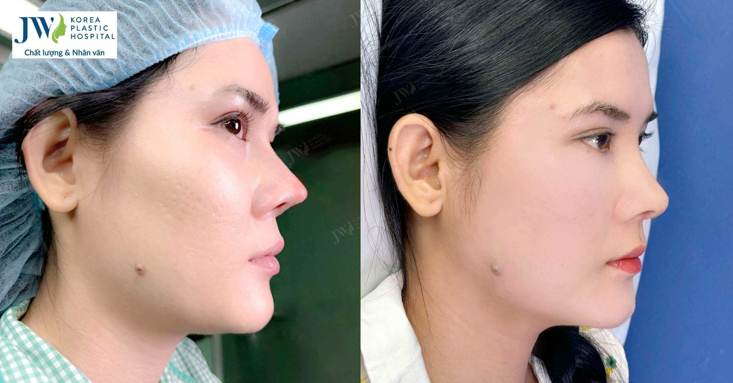 sua-mui-hong-thanh-mui-sline