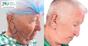 Quý ông U80 trẻ 30 tuổi sau khi căng da mặt tại Bệnh viện JW