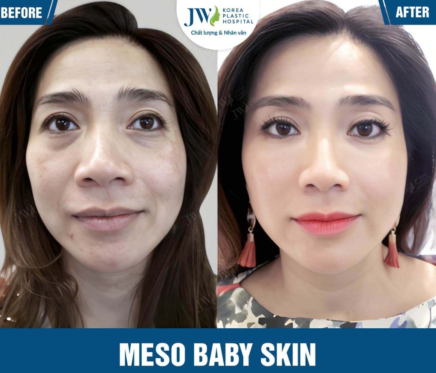 cong nghe meso baby skin