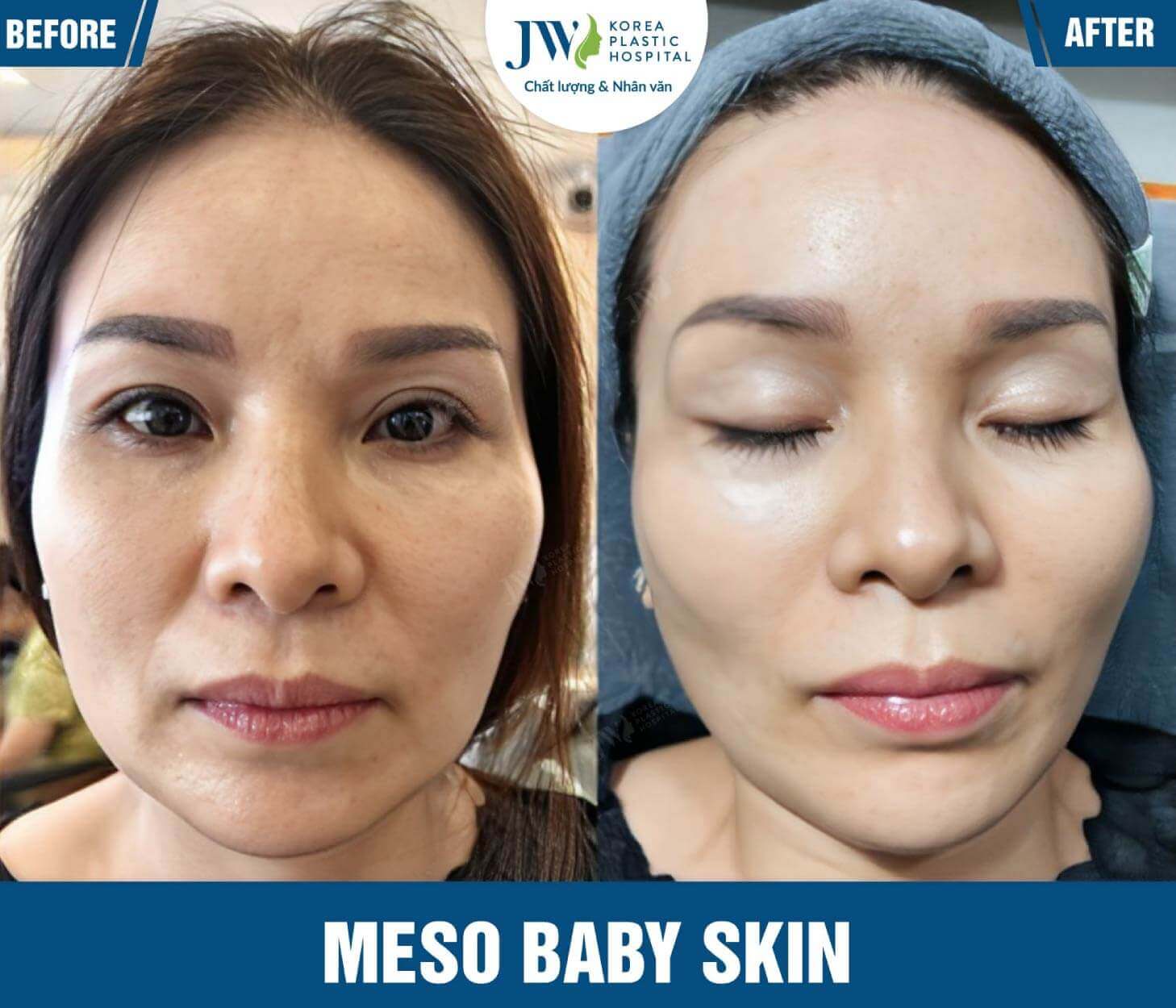 da nhan vung mat meso baby skin