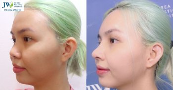 Chọn địa chỉ nâng mũi S Line uy tín để tránh biến chứng