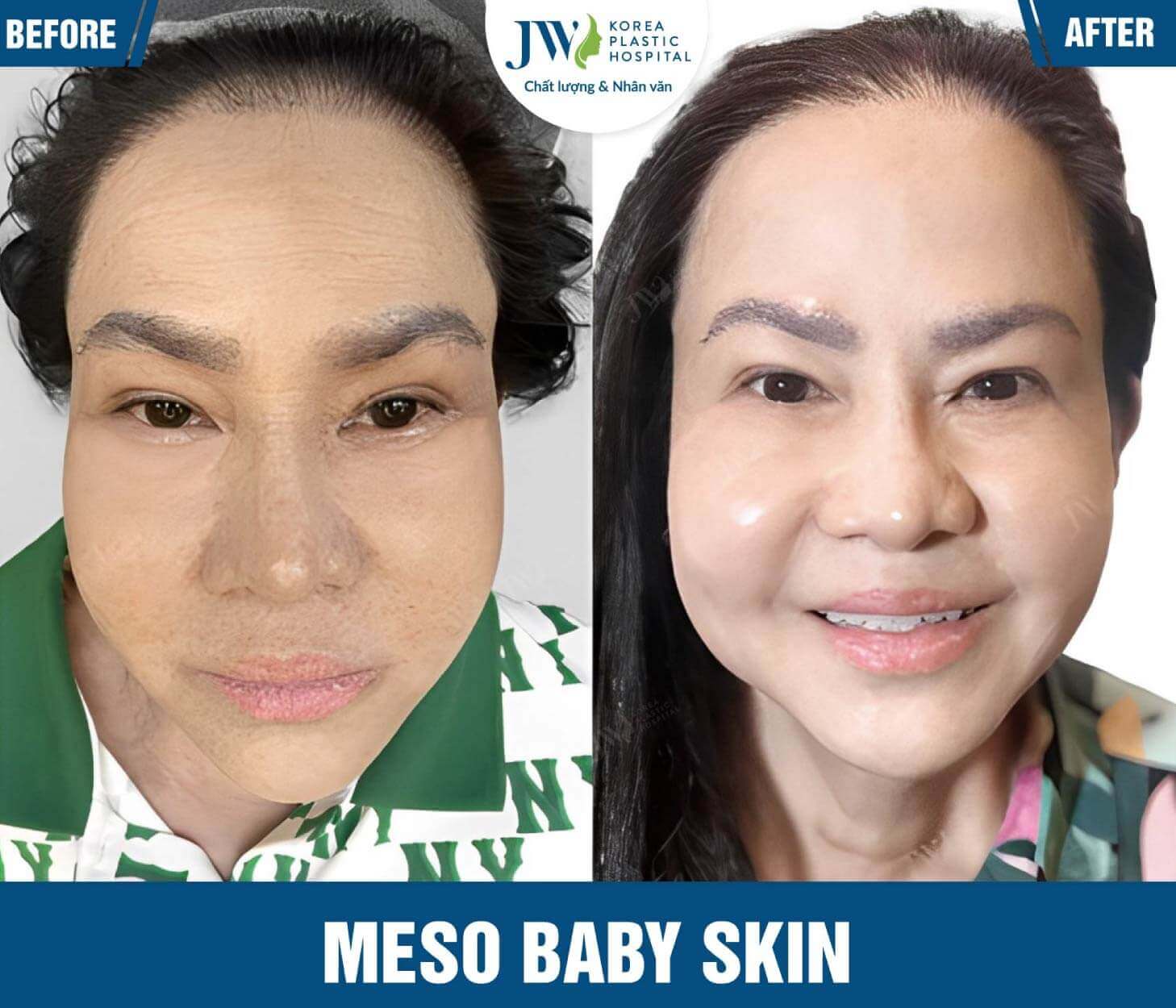 meso baby skin JW-2 