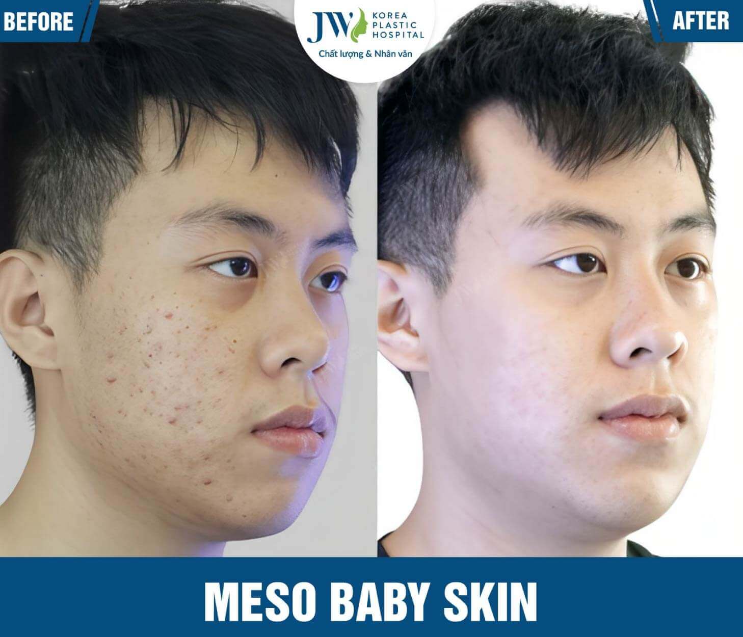 meso baby skin JW-1