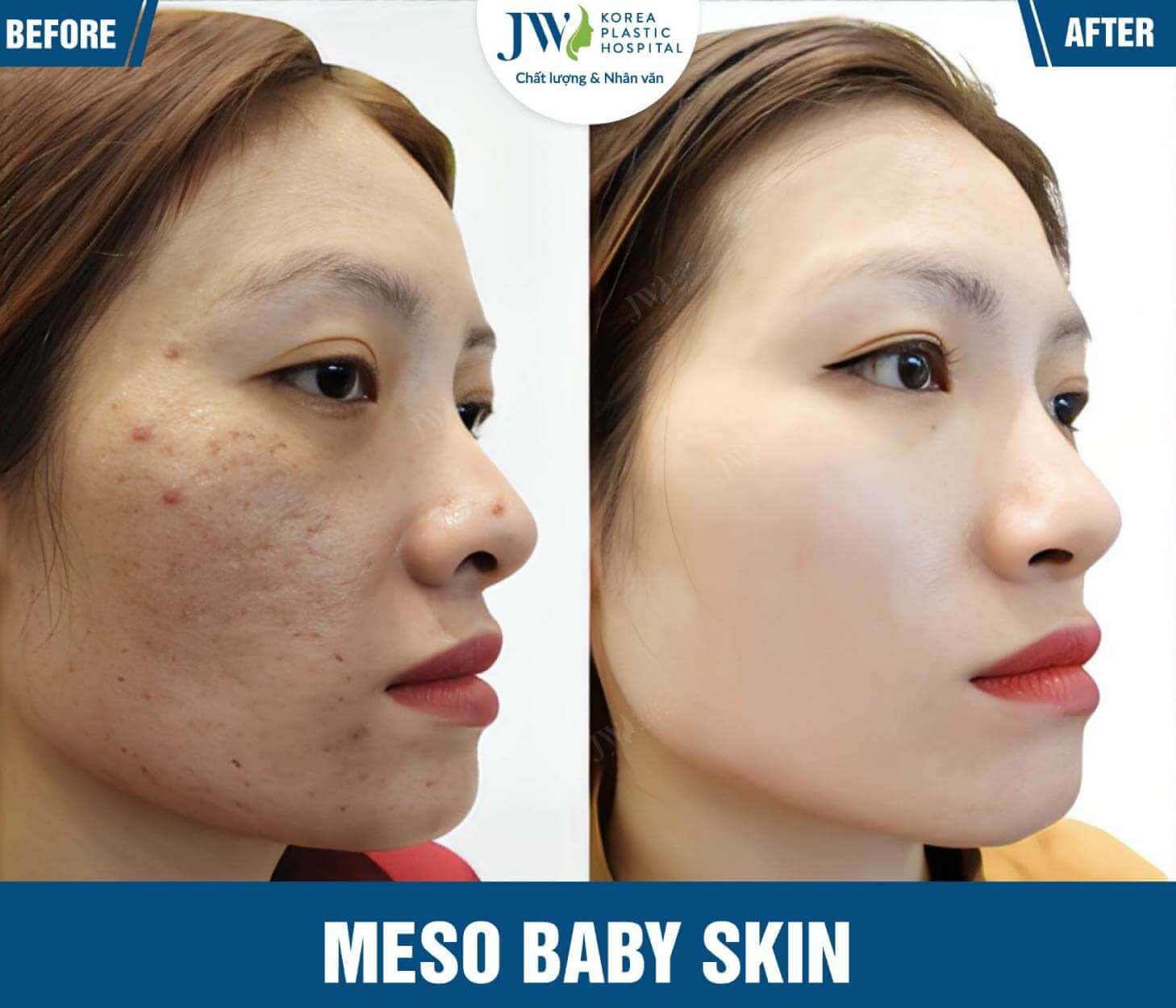 meso baby skin JW 