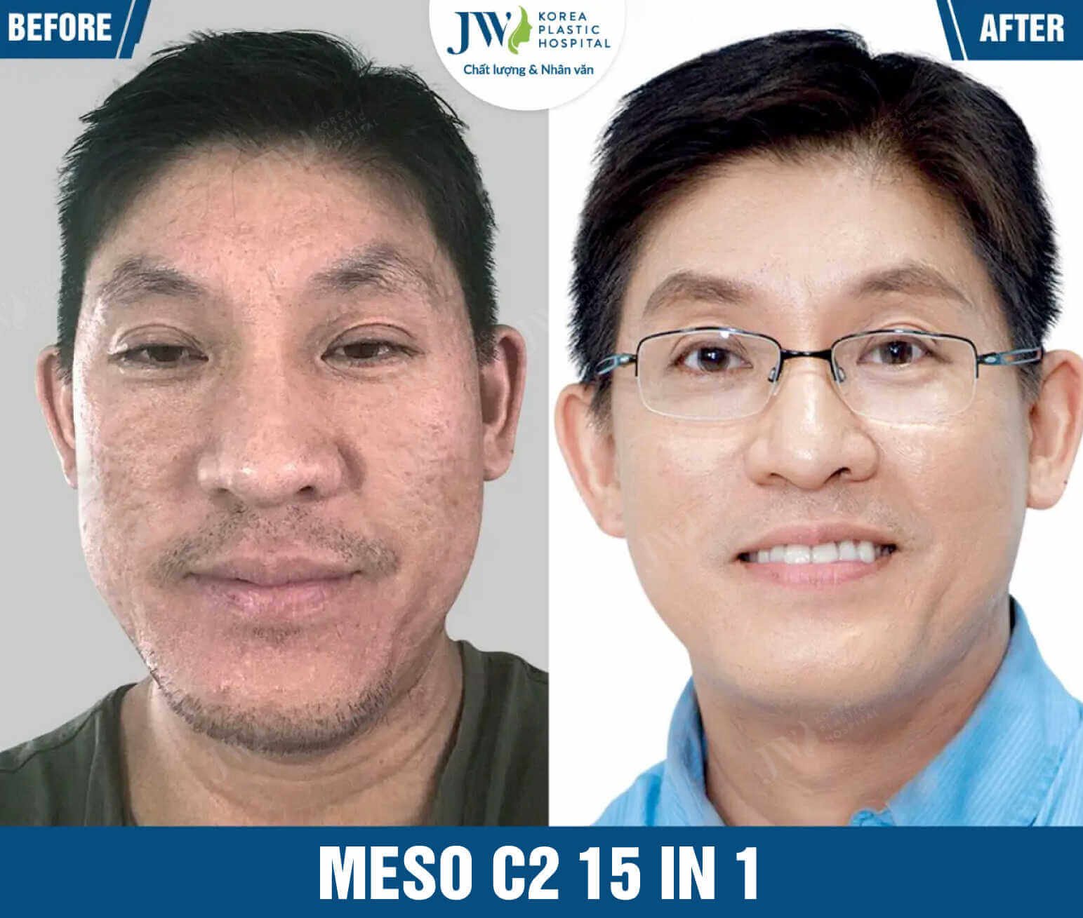 meso-c2-15-in-tai-jw