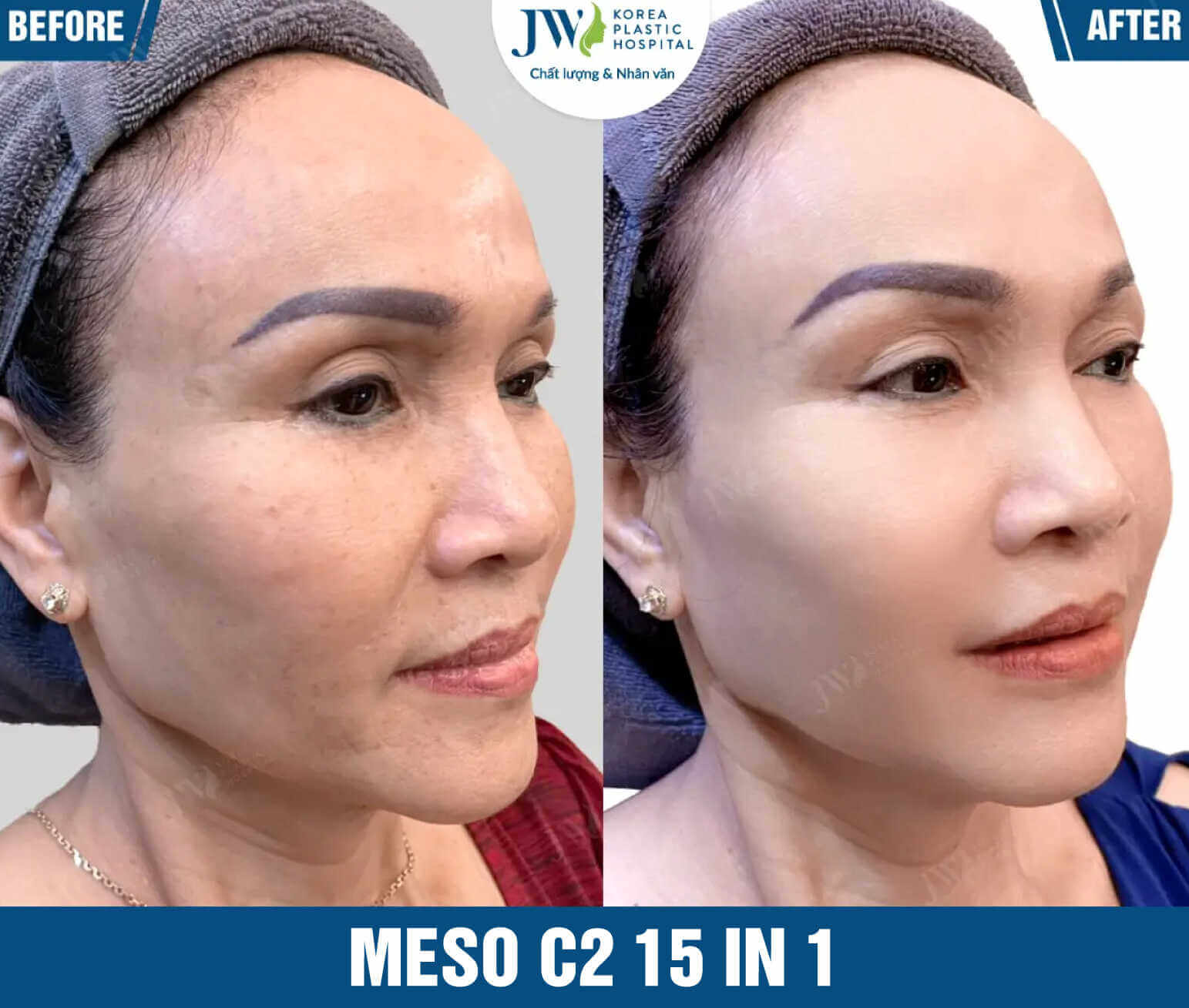 meso-c2-15-in-tai-jw