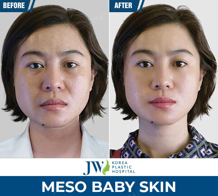 meso baby skin 1