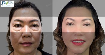 tre hoa mat khong phau thuat