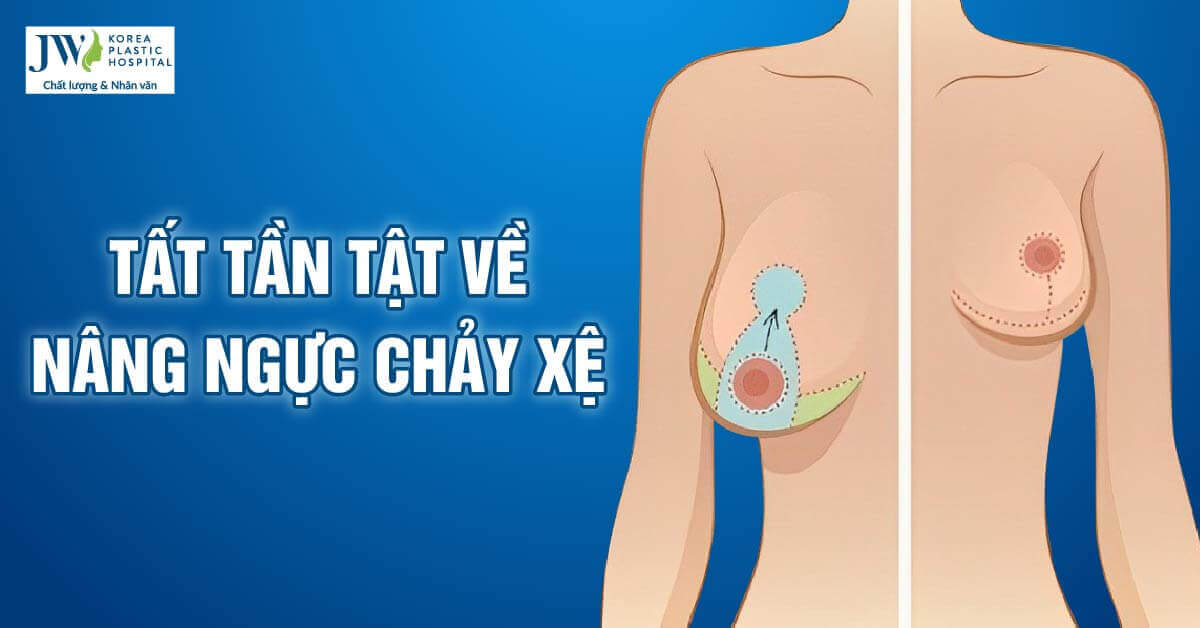ngực chảy xệ