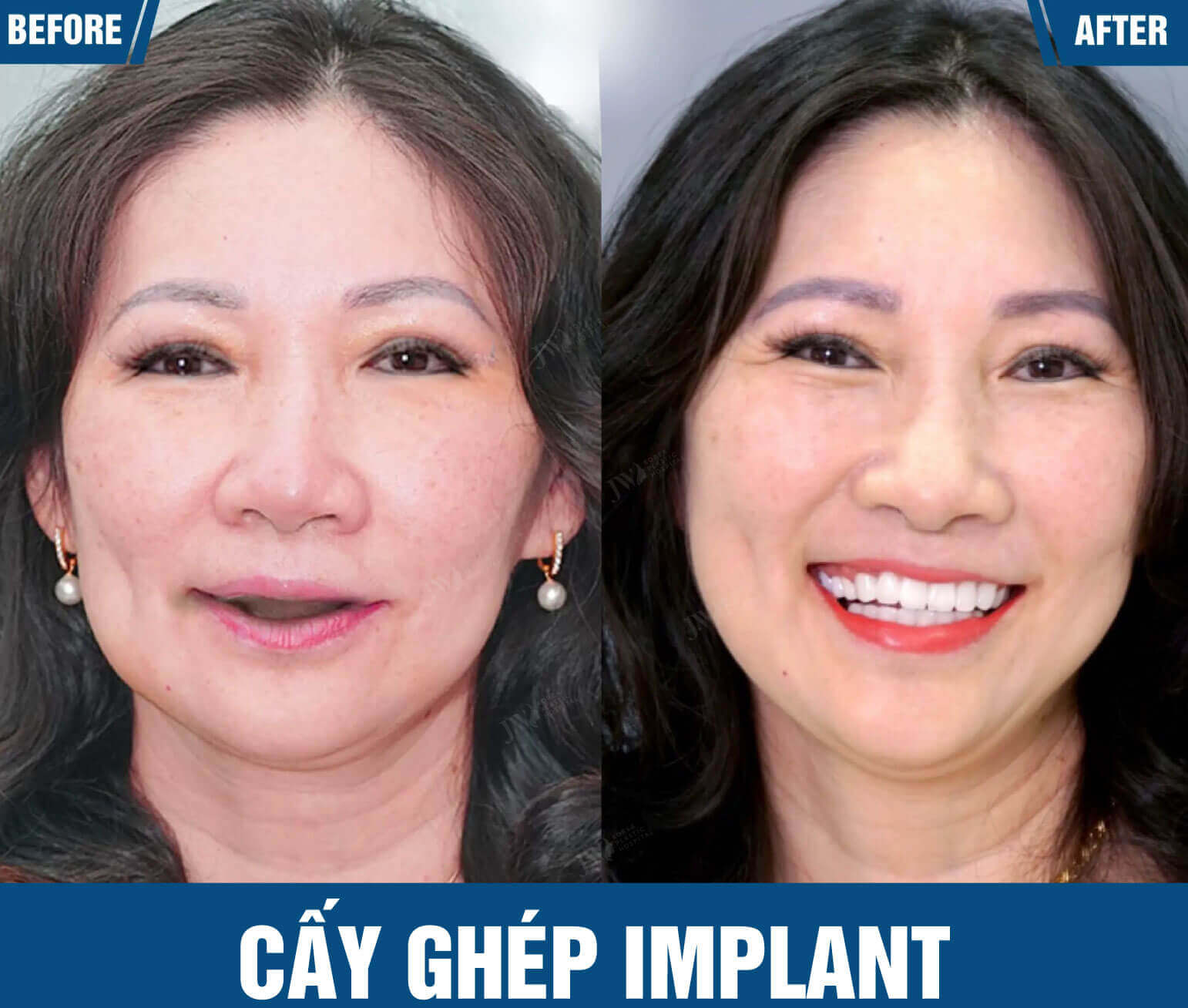 cay-ghep-implant