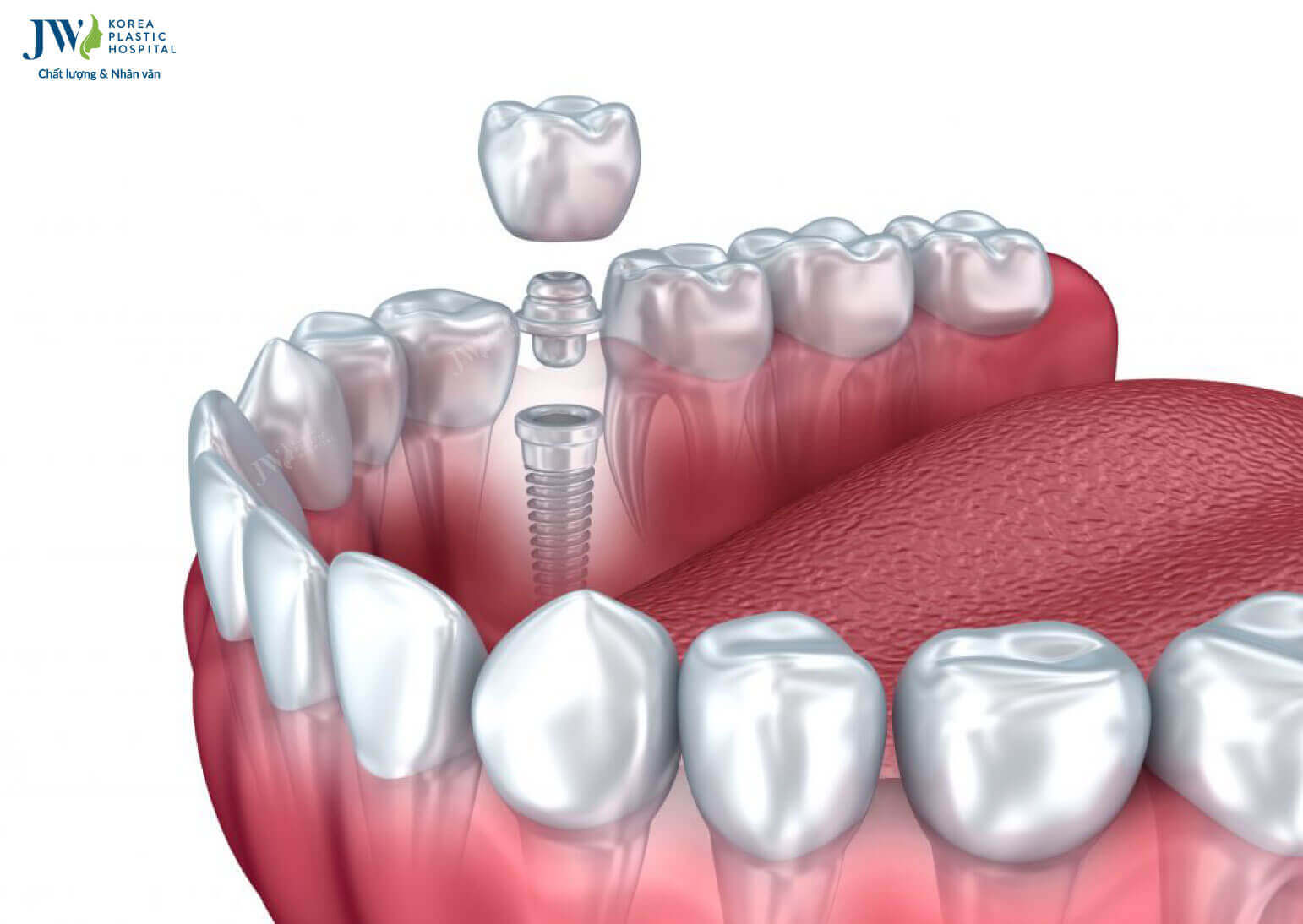 cay-ghep-implant-la-gi