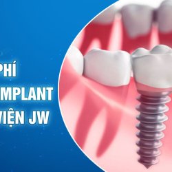 Chi phí cấy ghép Implant 2024 tại Bệnh viện JW 