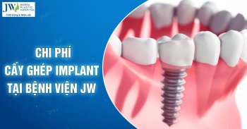 Chi phí cấy ghép Implant 2024 tại Bệnh viện JW