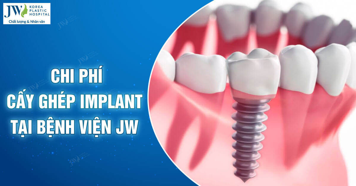 chi phí cấy ghép implant