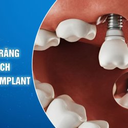 Chữa mất răng bằng cách trồng răng Implant  