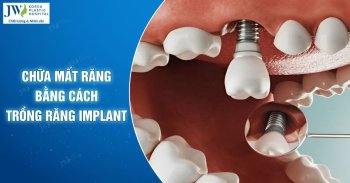 Chữa mất răng bằng cách trồng răng Implant