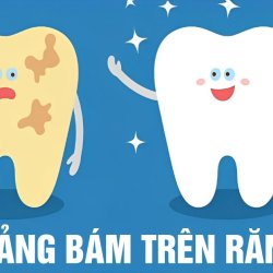 Nguyên nhân gây ra mảng bám răng và cách phòng ngừa