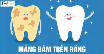 Nguyên nhân gây ra mảng bám răng và cách phòng ngừa