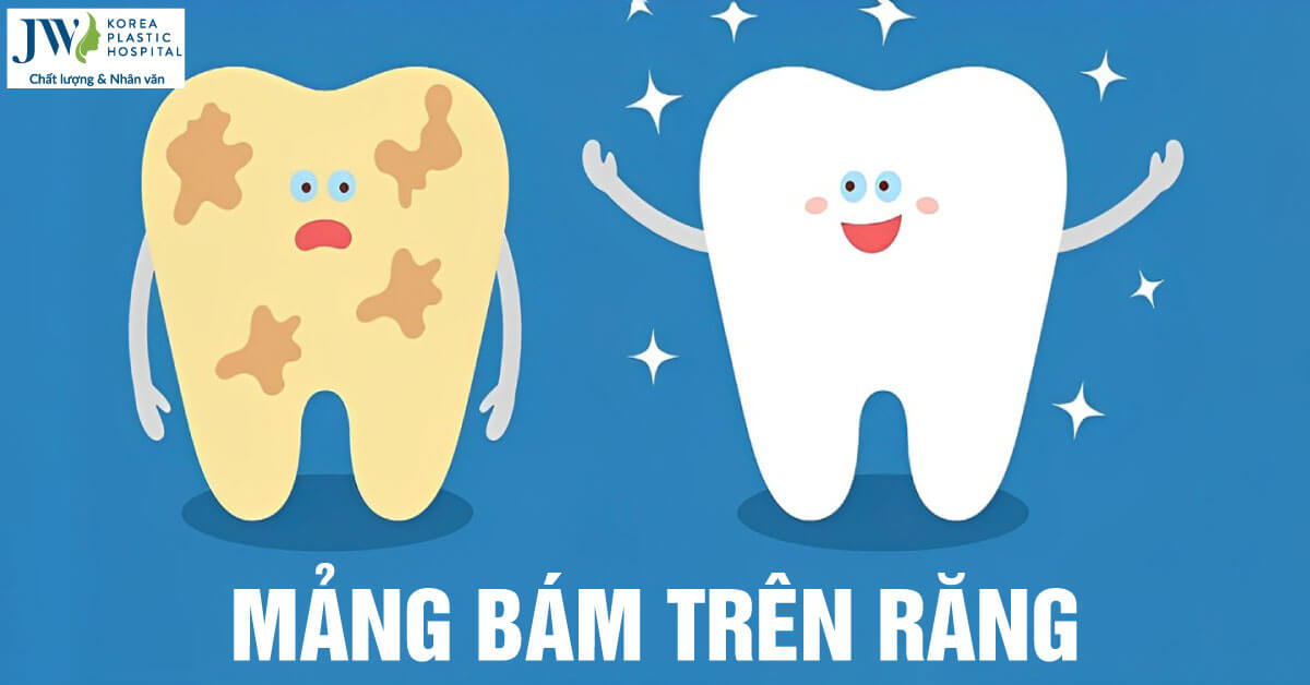 mảng bám răng