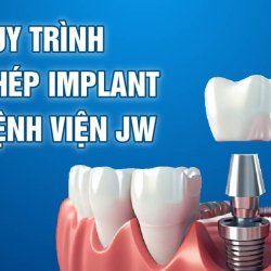 Quy trình cấy ghép Implant tại Bệnh viện JW thế nào?