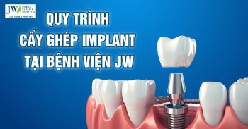 Quy trình cấy ghép Implant tại Bệnh viện JW thế nào?