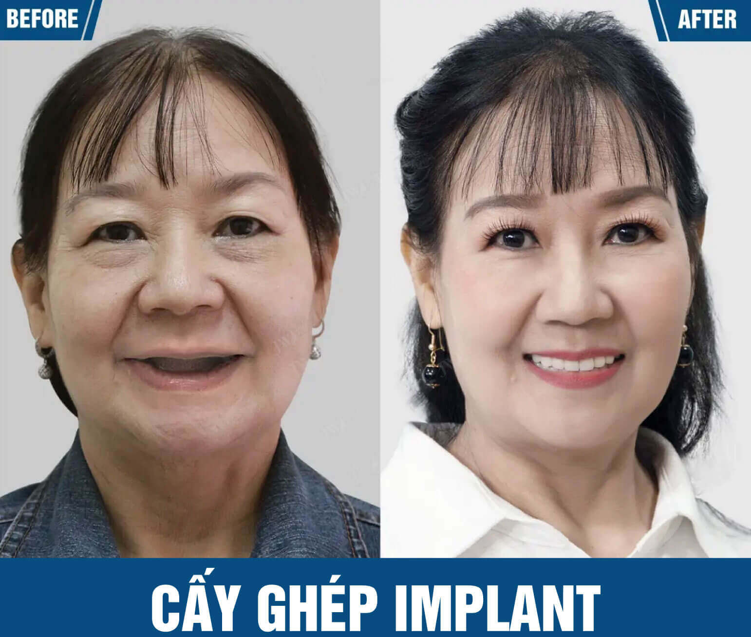 trong rang implant