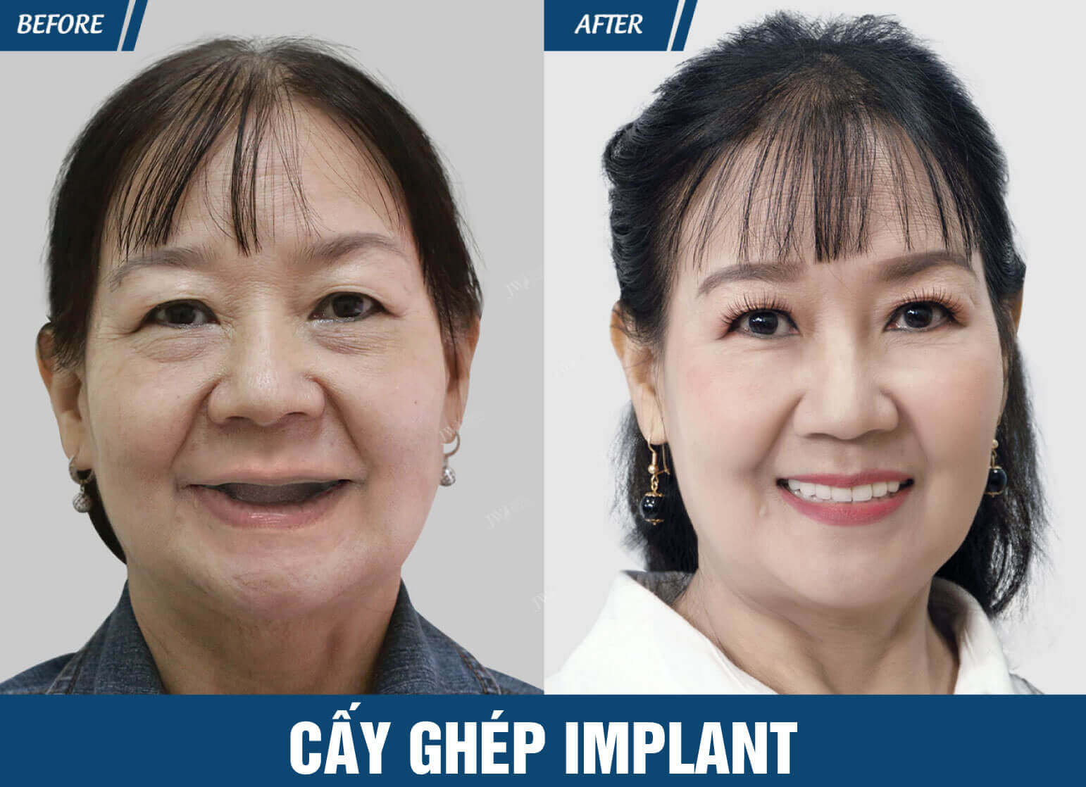 cay-ghep-implant