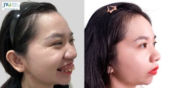 Nữ sinh Gen Z tự tin với diện mạo mới sau khi phẫu thuật hàm hô tại JW