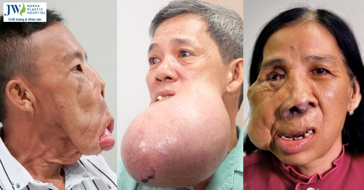 điều trị dị tật